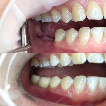 Восстановление 26 и 27 зубов