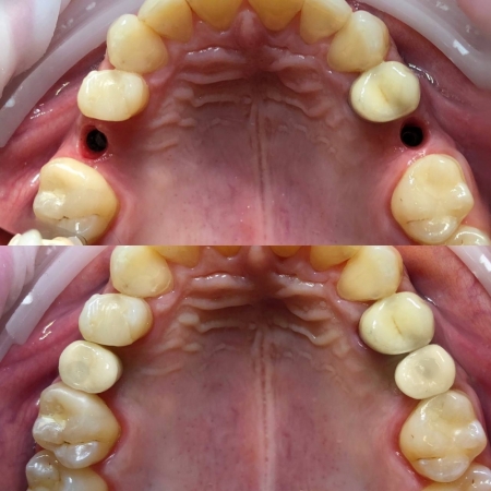 Восстановление 15,45 зубов с помощью одномоментной имплантации 