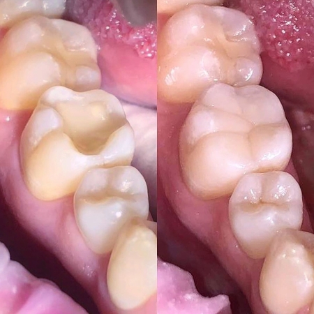 Художественная реставрация 36 зуба после лечения кариеса