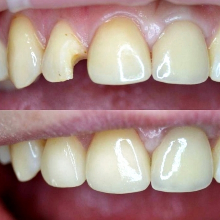 Художественная реставрация 12 зуба