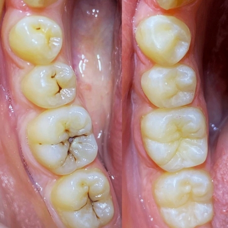 Лечение кариеса 45,46,47 зубов
