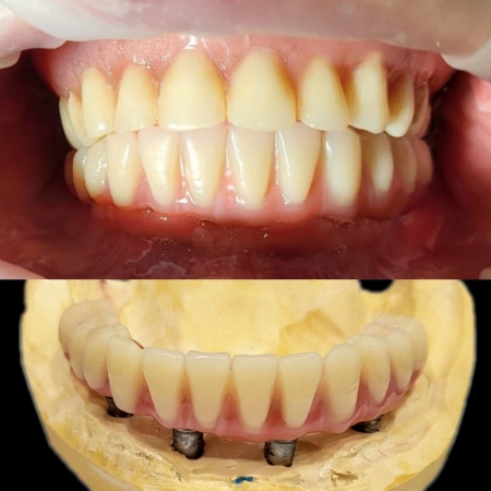 All-on-4, восстановление зубов нижней челюсти неъемным протезом на 4-х имплантантах