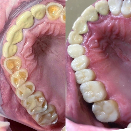 Восстановление коронок зубов при сильной стираемости керамическими вкладками