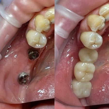 Восстановление 25, 26, 27 зубов с помощью установки моста из диоксида цирония на 2х имплантантах