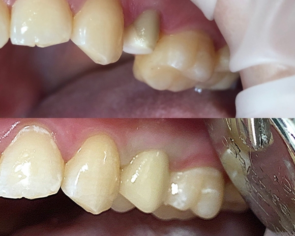 Восстановление 5-го зуба вкладкой и коронкой на основе диоксида циркония