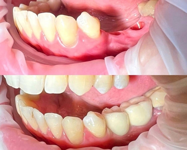 Установка имплантантов и металлокерамических коронок в район 33 и 36 зубов