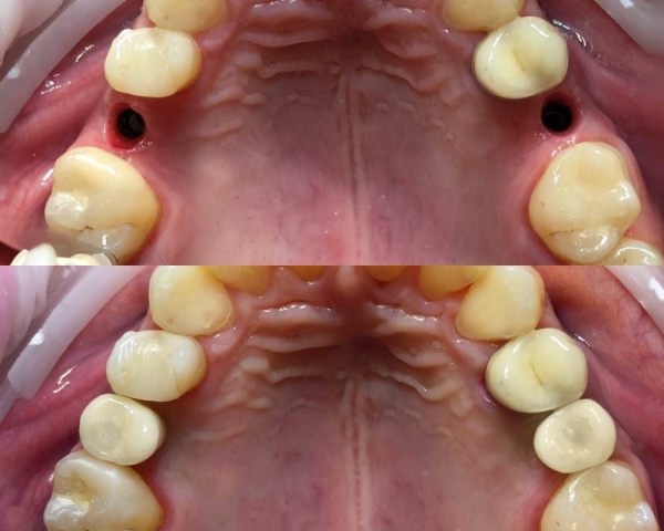 Восстановление 15,45 зубов с помощью одномоментной имплантации 