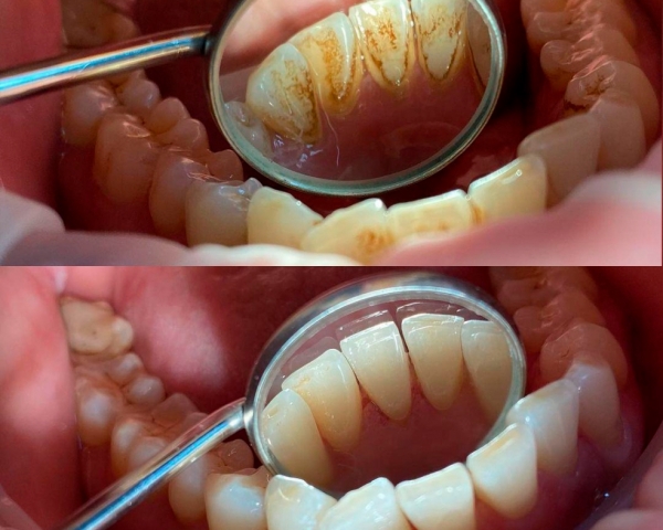 Фото до и после гигиенической чистки зубов