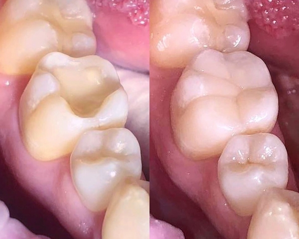 Художественная реставрация 36 зуба после лечения кариеса