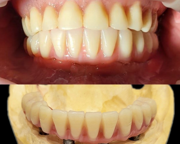 All-on-4, восстановление зубов нижней челюсти неъемным протезом на 4-х имплантантах