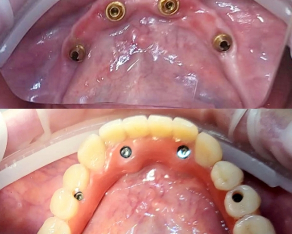 Протезирование нижней челюсти на 4-х имплантантах (All-on-4)