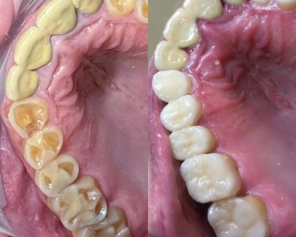 Восстановление коронок зубов при сильной стираемости керамическими вкладками