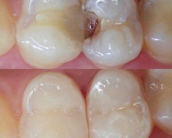 Лечение контактного криеса 34 и 35 зубов